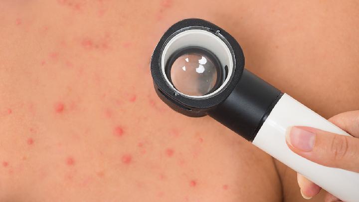 大腿根部湿疹应该怎么护理？
