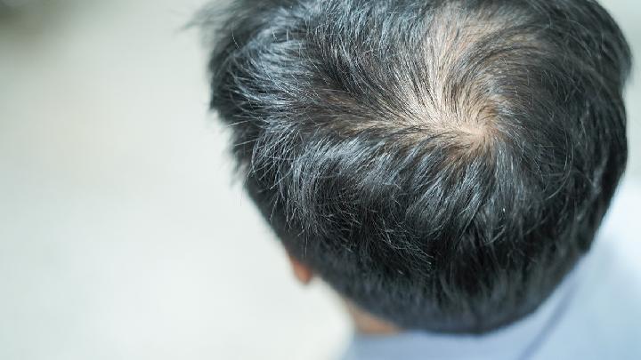脱发患者适合戴帽子吗?