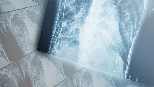 如果刚感染肺炎要怎样确诊