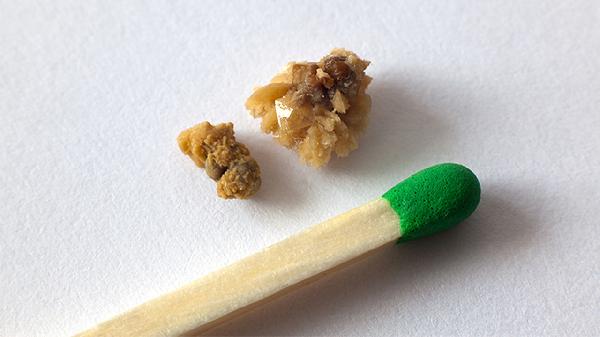 左肾有22mm的结石需要怎么治好