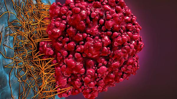 颅内假性动脉瘤的治疗方法有哪些