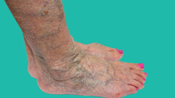 视网膜水肿怎么回事 怎么办