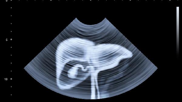 肝脏弥漫性改变是怎么回事