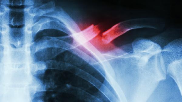 甲状旁腺功能亢进症的症状是什么