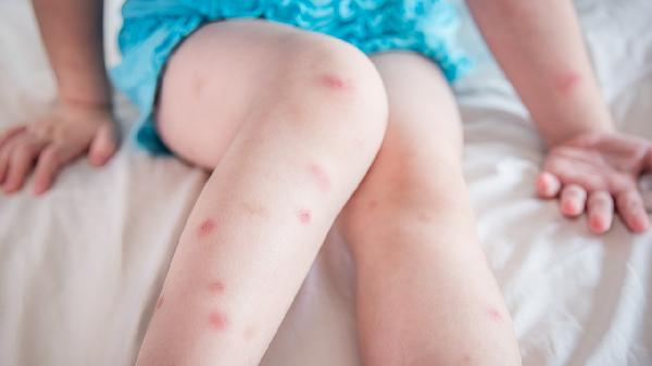 类风湿关节肿痛用什么方法最快消肿止痛