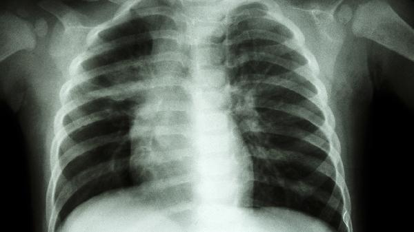 鸡胸应该注意什么 鸡胸患者生活要注意这五点