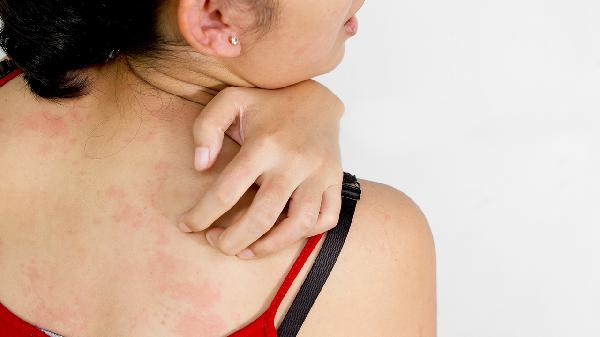 得疱疹不能吃什么东西