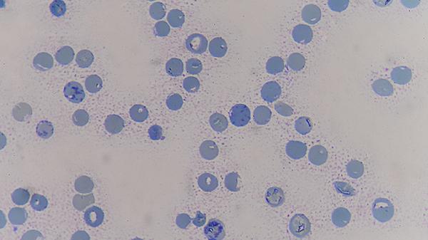 活检结果误诊为癌症几率大吗