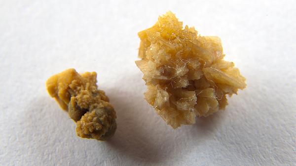 结石在膀胱里排不出来怎么办