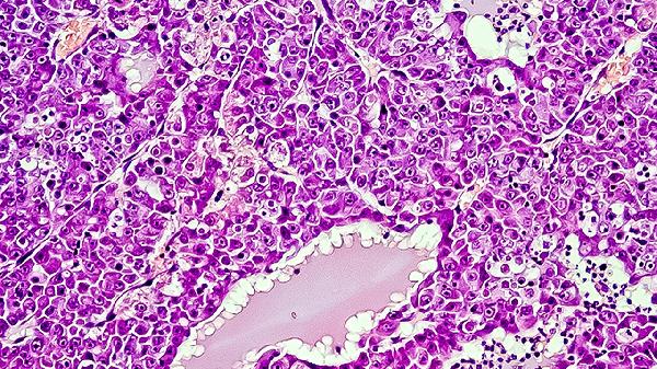 星形细胞瘤三级能活一辈子吗