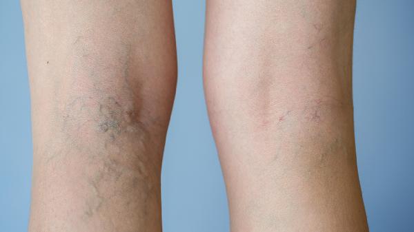 上眼皮水肿眼皮皮肤痒怎么回事