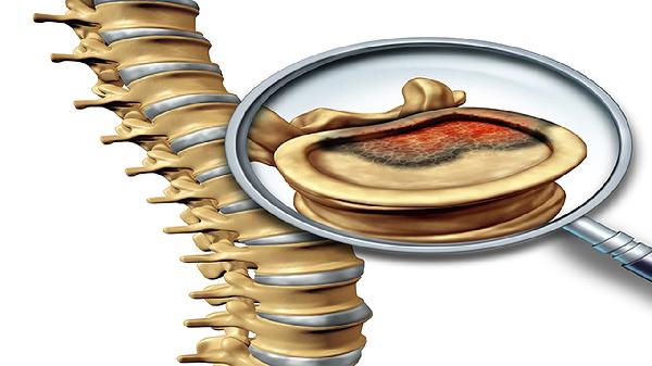 l4-S1椎间盘突出是什么意思