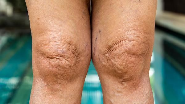 心源性水肿的症状有哪些 心源性水肿的四大症状