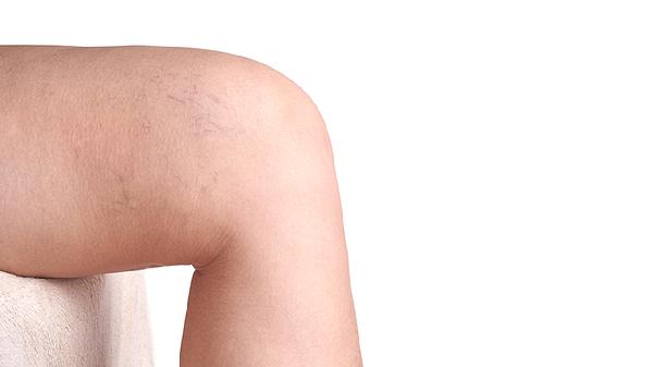 髋关节滑膜炎能走路吗 髋关节滑膜炎多久能走路