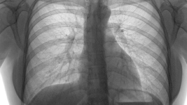 急性肺动脉栓塞可以采取哪些非手术治疗措施