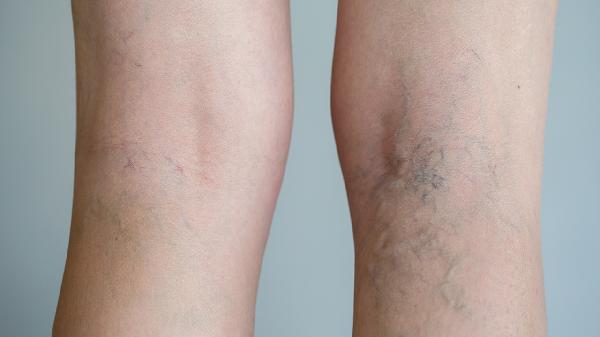 身上出风湿疙瘩是怎么回事