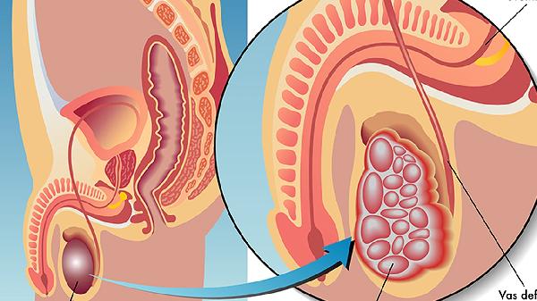 睾丸一高一低很明显