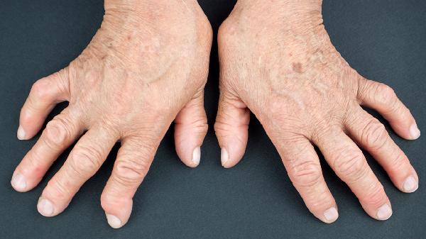 干燥综合征的症状有哪些  干燥综合征6大症状很复杂