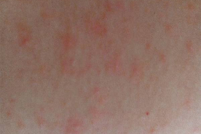 过敏性紫癜能喝豆浆吗