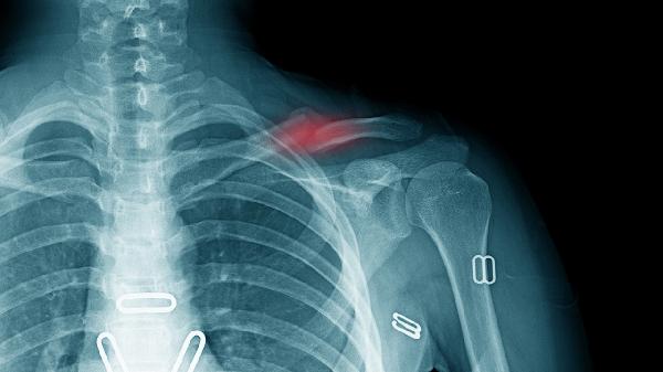 骨质欠规整是轻微骨折吗