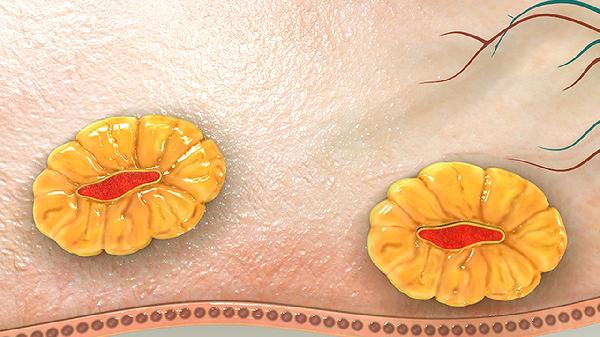 脑血管堵塞严重吗