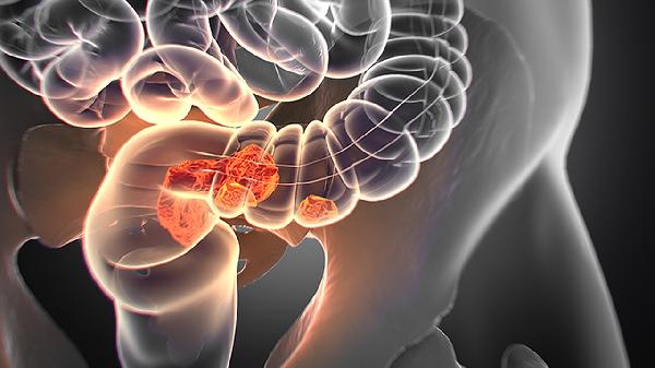 直肠癌会通过哪些手术方法治疗 解说直肠癌的四种手术方法