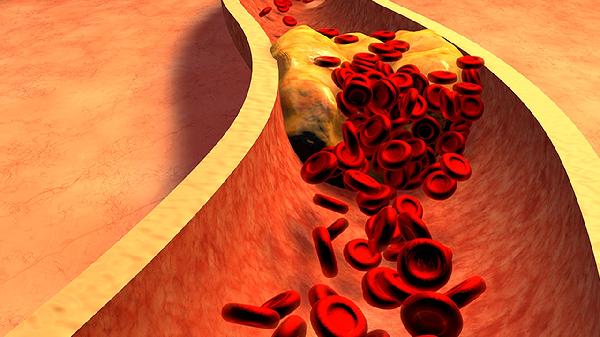 运动神经元病怎么引发的 详述运动神经元病的几个病因