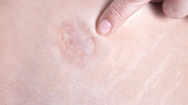 创伤性气道狭窄的治疗方法有哪些