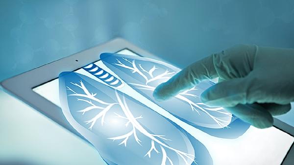 得了肺癌能治好吗 四个方法结合控制肺癌侵袭