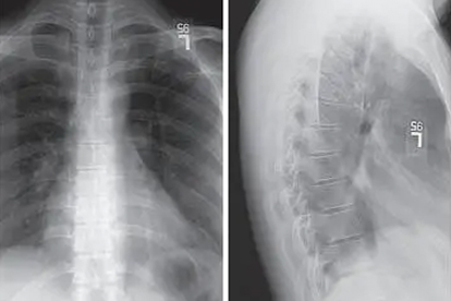胸椎里边疼是怎么回事