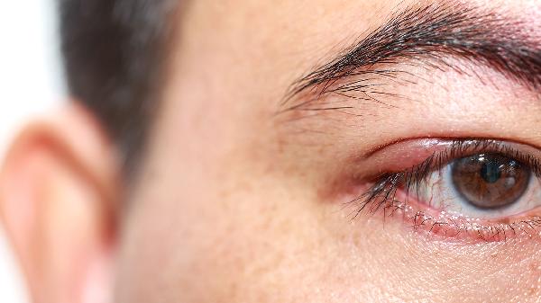 麦粒肿化脓流到眼睛里怎么办