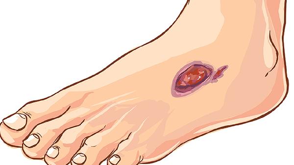 脚崴了怎么样处理效果最好