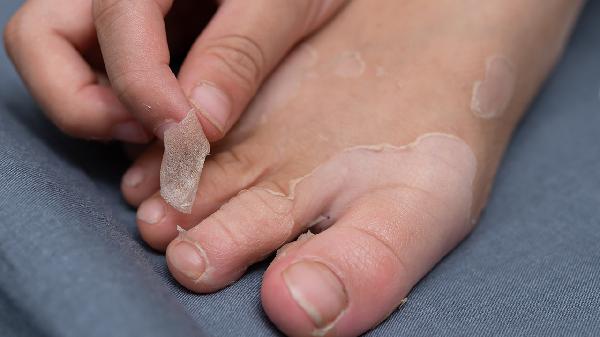 嘴唇干裂脱皮是怎么回事 脾虚可以这样护理