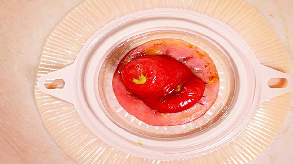 疝的病理解剖有哪些