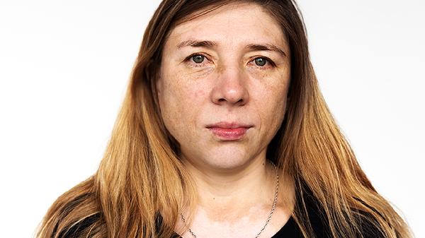 围绝经期综合征使用激素治疗会有什么危害