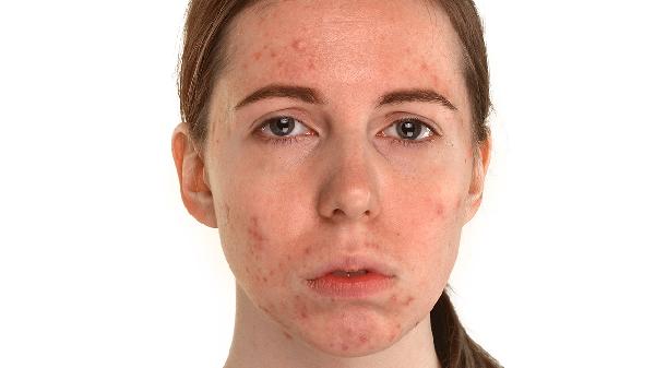 治疗过敏性紫癜应该看什么科