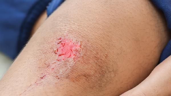 双氧水洗伤口的功效