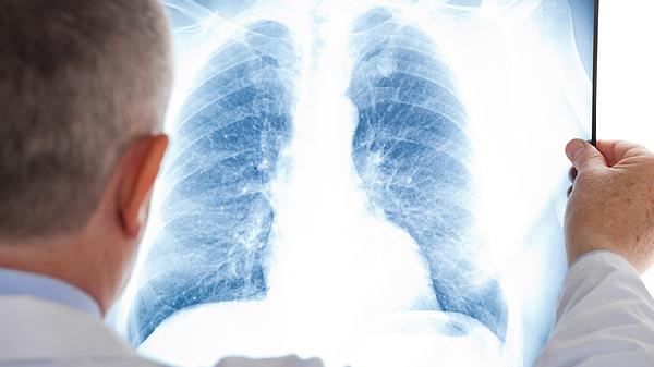 肺微浸润腺癌切除后是不是就没事了