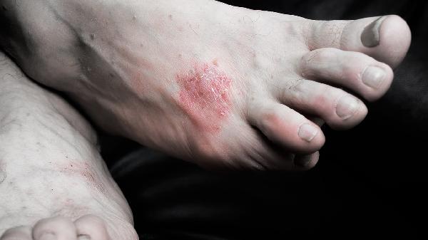 牛皮癣是自身免疫性疾病吗