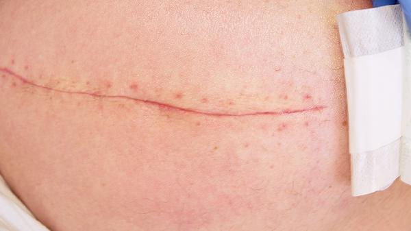 包皮手术二次缝合多久恢复