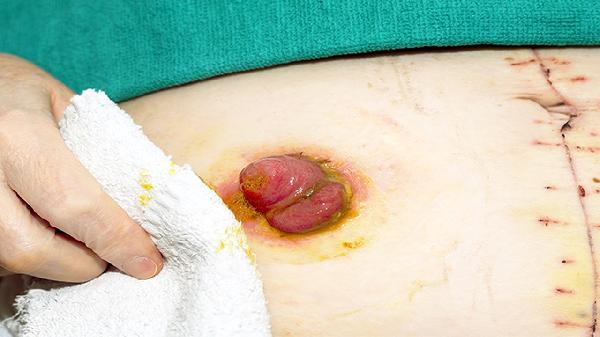 儿童食管裂孔疝的常见症状有哪些