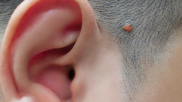 纤维瘤是什么原因造成的 怎么治