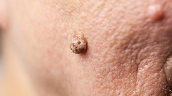 怎么把骨化纤维瘤检查出来