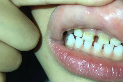 蛀牙不适合吃的食物