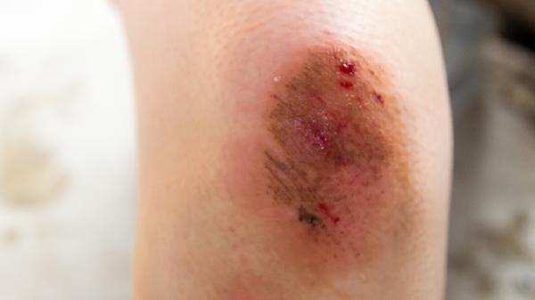 吃什么促进伤口愈合快 掌握正确饮食方法促伤口愈合