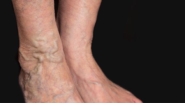 小腿浮肿腰痛蛋白尿及血肌酐偏高怎么回事