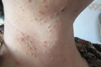 扁平疣用药膏多久可以去除掉