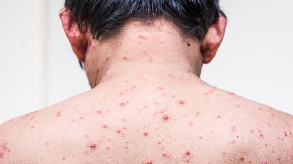 阿比多尔治疱疹吗