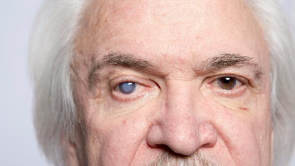 老年白内障治疗费用要多少