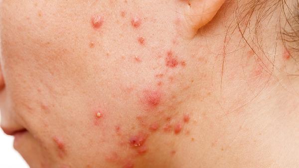 胃黄斑瘤怎么治疗